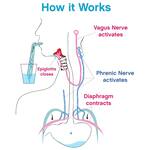 HiccAway Hiccup Straw - Stops Hiccups Fast and Naturally